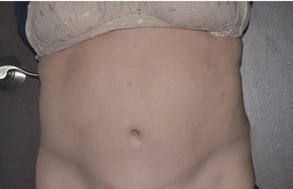 tummy tuck after