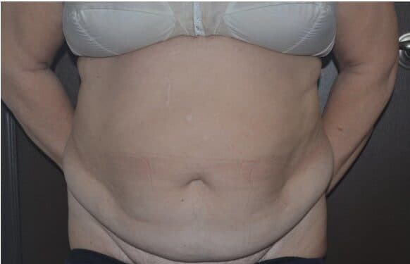 tummy tuck before