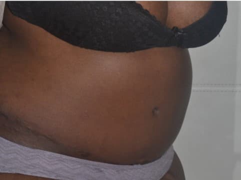 tummy tuck after
