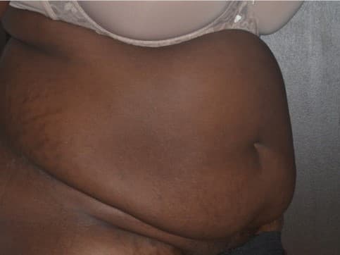 tummy tuck before