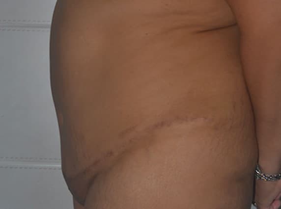 tummy tuck after