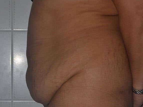 tummy tuck before
