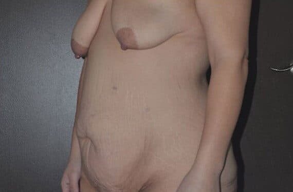 tummy tuck before