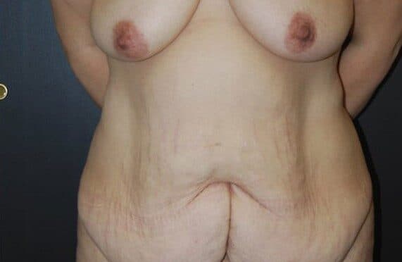 tummy tuck before