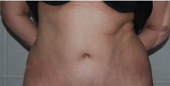 tummy tuck after