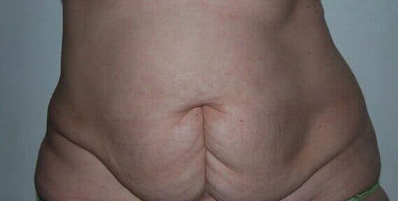 tummy tuck before