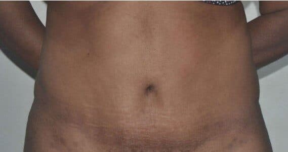 tummy tuck after