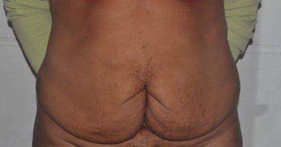 tummy tuck before