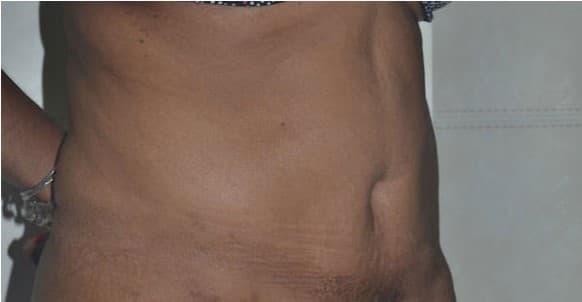 tummy tuck after