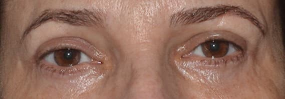 upper lower eyelid after