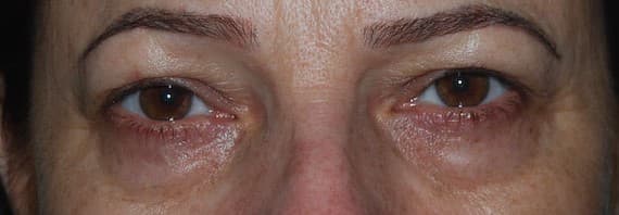 upper lower eyelid before