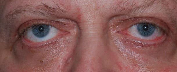 upper lower eyelid after