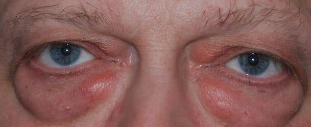 upper lower eyelid before
