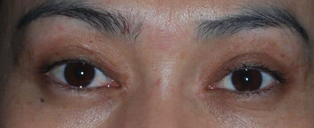 upper lower eyelid after