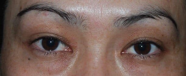 upper lower eyelid before