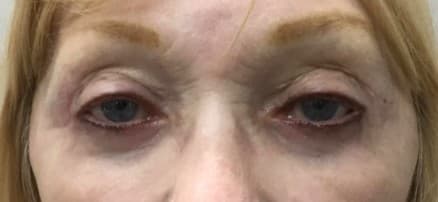 upper lower eyelid after