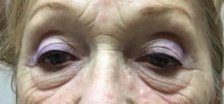 upper lower eyelid before