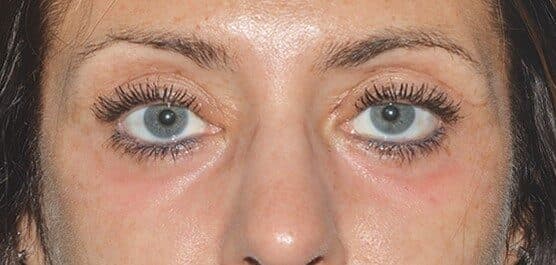 upper lower eyelid after