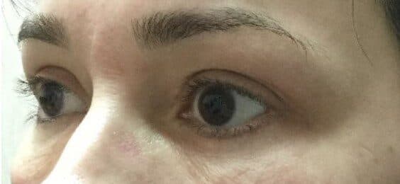 upper lower eyelid after