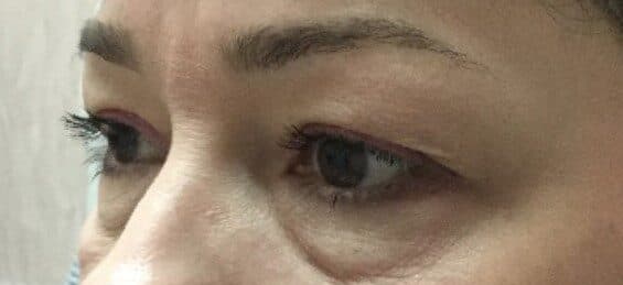 upper lower eyelid before