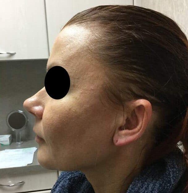 y lift after