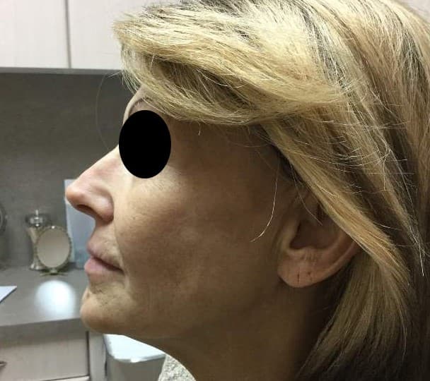 y lift after