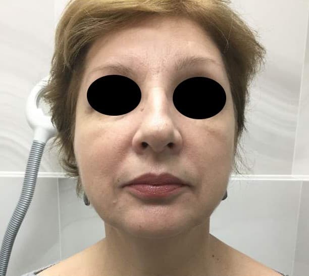 y lift after