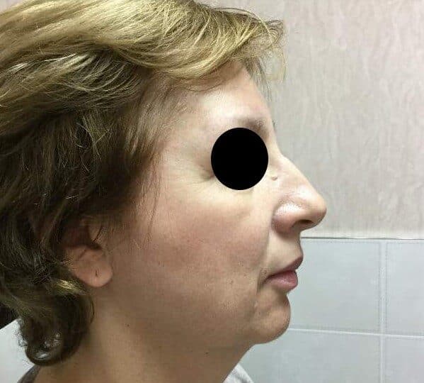 y lift before